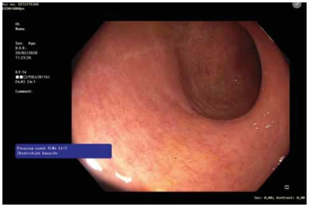 The last total colonoscopy was performed in February 2020 with complete endoscopic
healing. <br> 
Obr. 1. Poslední úplná koloskopie byla provedena v únoru 2020 s nálezem kompletní ho
endoskopického zhojení.
