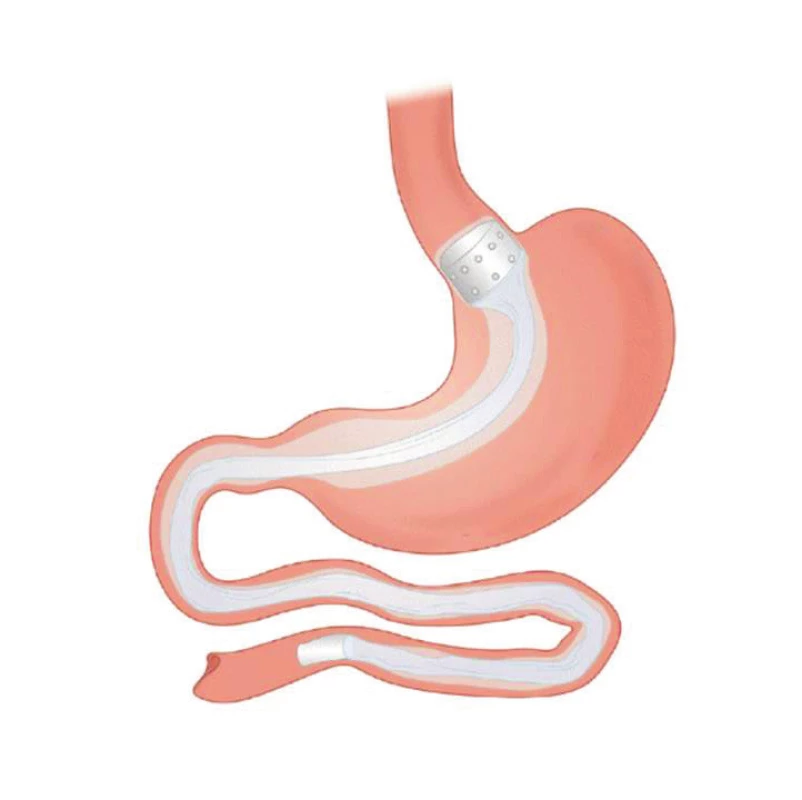 Gastroduodenojejunální rukáv<br>
Fig. 2: Gastroduodenojejunal sleeve