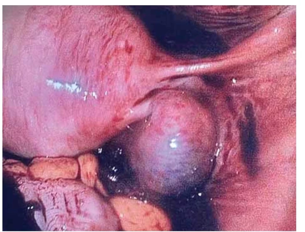 Nález z laparoskopie 22. 5. 2022 – hemoperitoneum, pravá tuba téměř
celá destruována ektopickou tubární graviditou.<br>
Fig. 3. Findings from laparoscopy May 5th, 2022 – hemoperitoneum, the right tube
almost completely destroyed by ectopic tubal pregnancy.