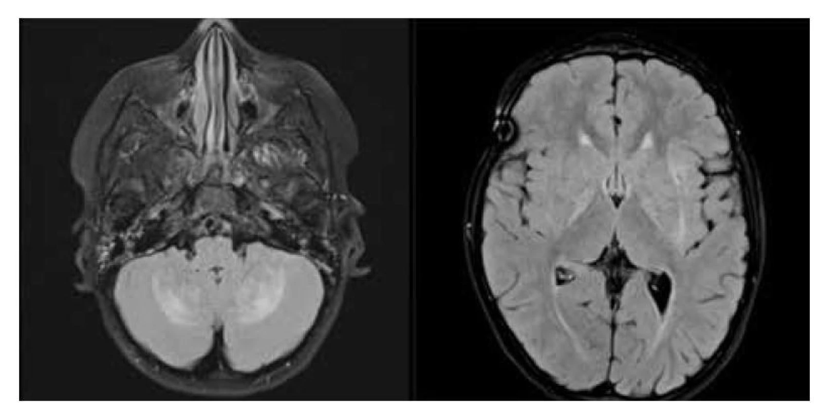 Neurodegenerace při LCH: a) MR scan – FLAIR sekevence v axiální rovině, hyperintenzní
léze mozečkových hemisfér a nuclei caudati bilat., b) MR scan – FLAIR sekevence
v axiální rovině, hyperintezní léze v bazálních gangliích oboustranně.<br>
Fig. 6. LCH neurodegeneration: a) MR FLAIR scan in axial plane, bilateral symmetric parenchymal
lesions of the cerebellum in the dentate nuclei, b) MR FLAIR scan in axial plane, bilateral
hyperintense lesions of the basal ganglia.