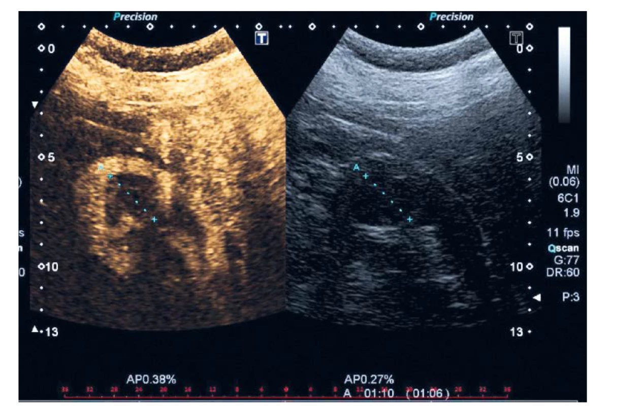 Sytící se periferie cystického ložiska (Bosniak IV, histologicky ccRCC pT1 G1) – obrázek vlevo<br>
Fig. 1. Enhancement of peripheral part of cystic lesion (Bosniak IV, histology ccRCC, pT14, G1) – left picture