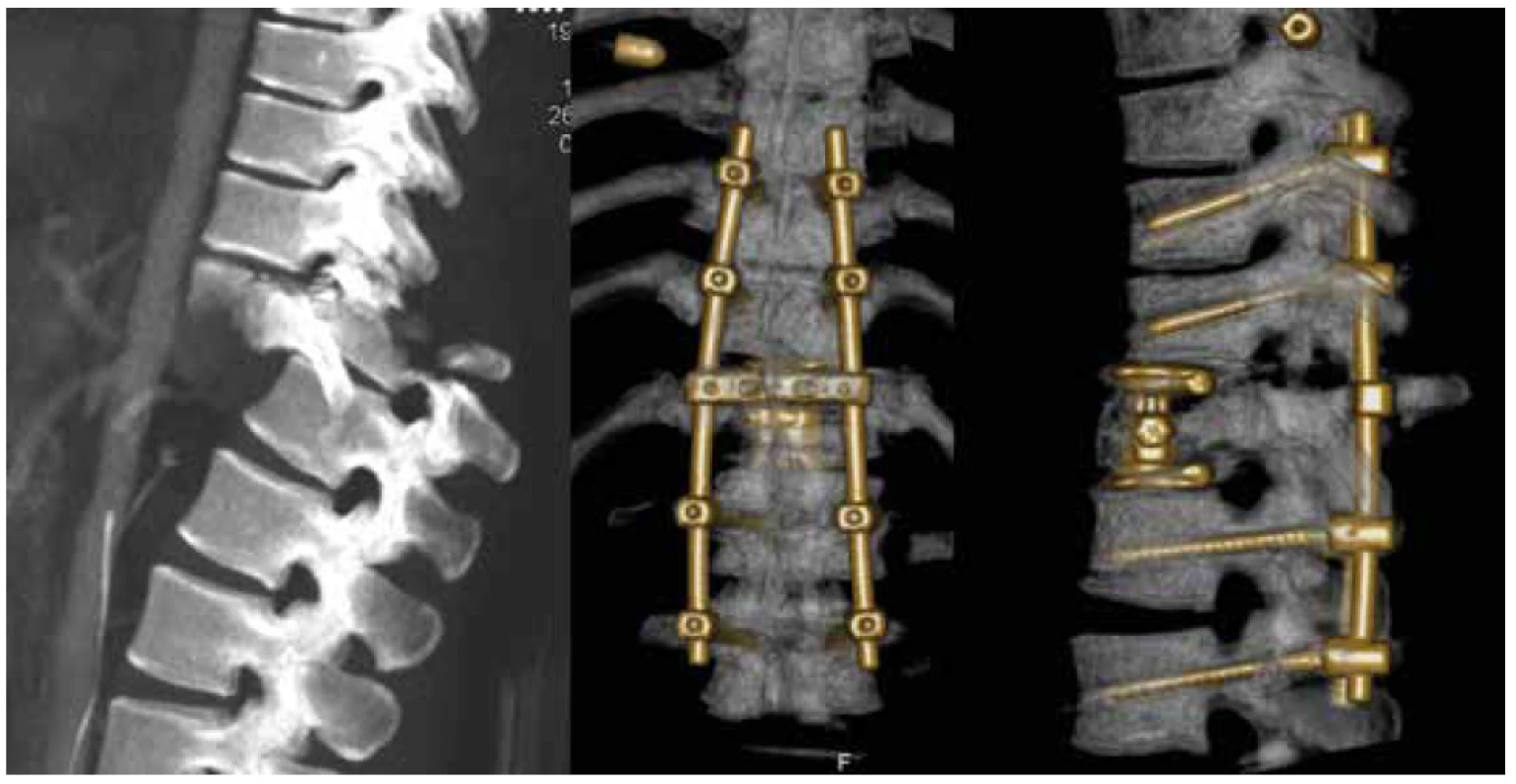 Dislokovaná zlomenina typu C s kompletní míšní lézi (N4) TL AOSIS – 12, řešená kombinovanou
dlouhou instrumentací<br>
Fig. 4. C type fracture with dislocation and complete spinal cord leasion (N4) TL AOSIS – 12, treated by
long combined instrumentation