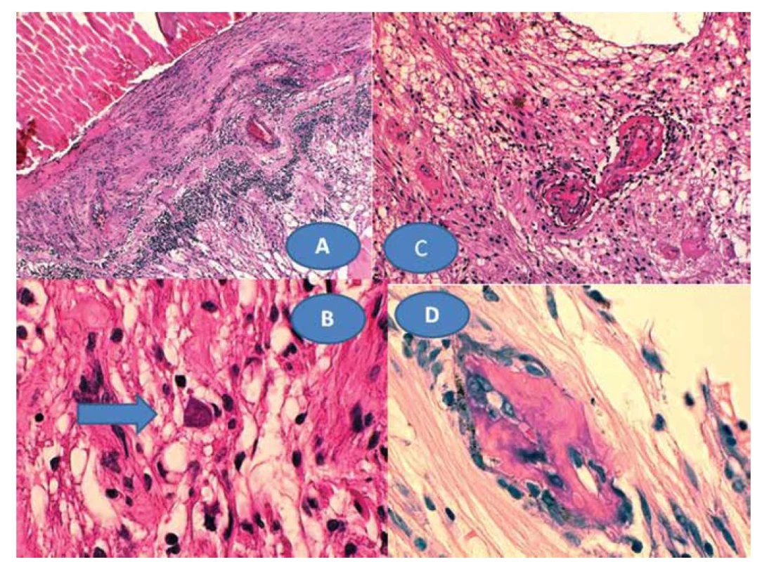 Chronická retinochoroiditida (A) zvětšení 50x, HE. Toxoplazmová cysta s bradyzoity – šipka (B), zvětšení 500x, HE.
Vaskulitida sítnice s trombózami (C), zvětšení 125x, HE. Mikrokalcifikace zachycené v granulomech (D), zvětšení 500x, HE