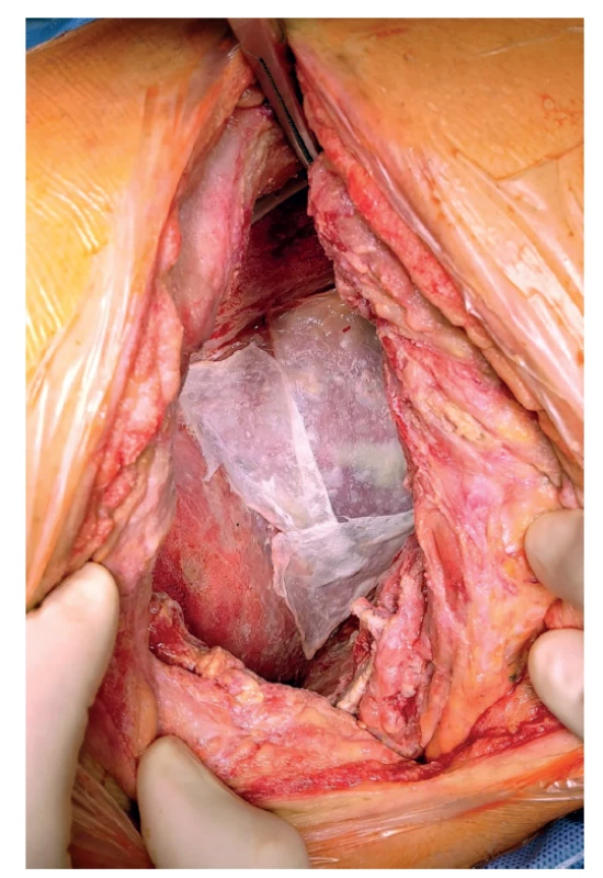 Překrytí pahýlů cév a bronchu garamycinovou
pěnou.<br>
Fig. 1: Blood vessel and bronchial stumps covered with
garamycin foam