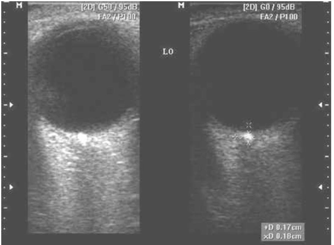 USG zobrazenie B-scan drúz terča optického nervu - III skupina
(podľa veľkosti)
