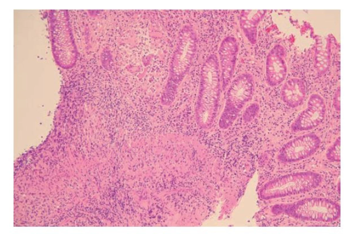 Bioptický odběr kolické sliznice u pacienta s Crohnovou chorobou.
V lamina propria je chronický zánět, který prostupuje do submukózy a je doprovázený
fibrotizací. Na více místech v lamina propria i v submukóze jsou
zastiženy vágně formované epiteloidní granulomy s přítomností mnohojaderných
buněk (hematoxylin a eosin, 200x).