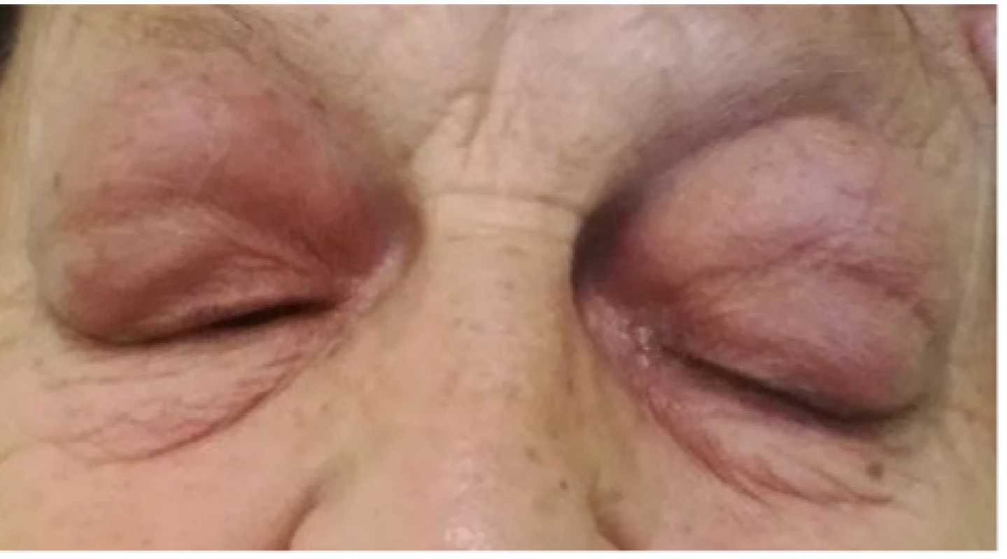 Patient 1 – bilateral, hyperemic tumours of the
upper eyelids