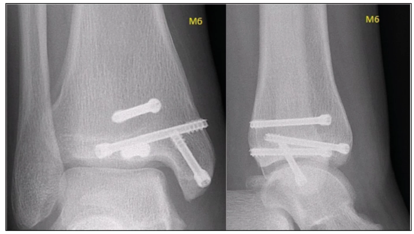 The patient was clinically observed until the growth plates have fully closed, i.e. for the period of further 16 months
