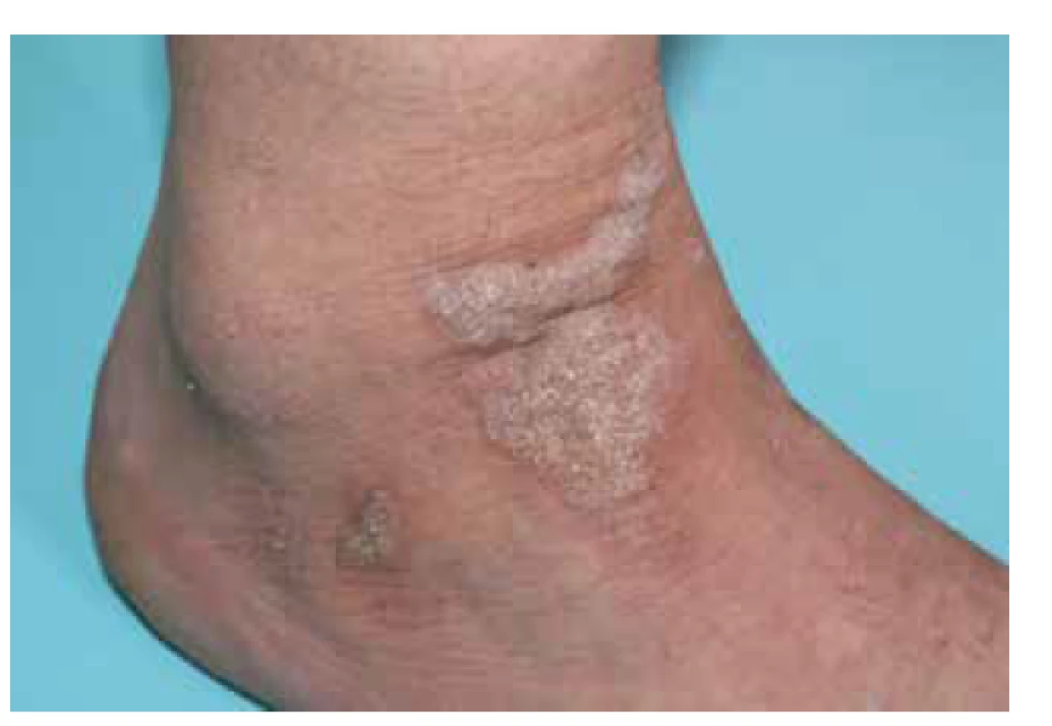 Lichen planus verrucosus