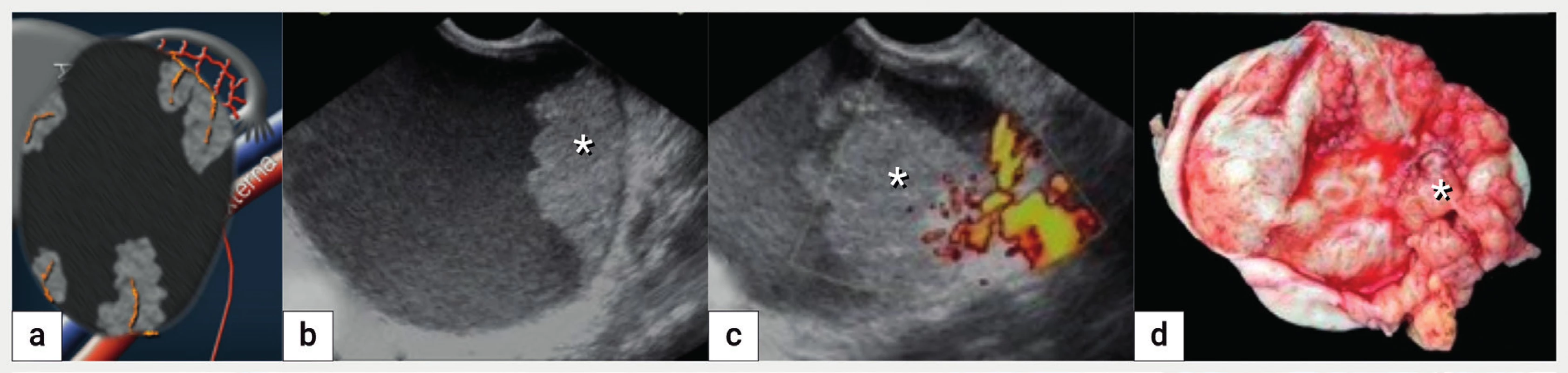 Maligní transformace endometroidní cysty<br>
Schéma unilokulární-solidní cysty s tekutinou vzhledu mléčného skla a vícečetnými solidními papilárními prominencemi s bohatou perfuzí (a),
ultrazvukové zobrazení v B-obraze (b), dopplerovské zobrazení perfuze uvnitř solidní papilární intracystické prominence (c), intraoperační nález
malignizace endometroidní cysty (podle histologie endometroidní adenokarcinom). Papilární intracystická prominence je označena hvězdičkou.