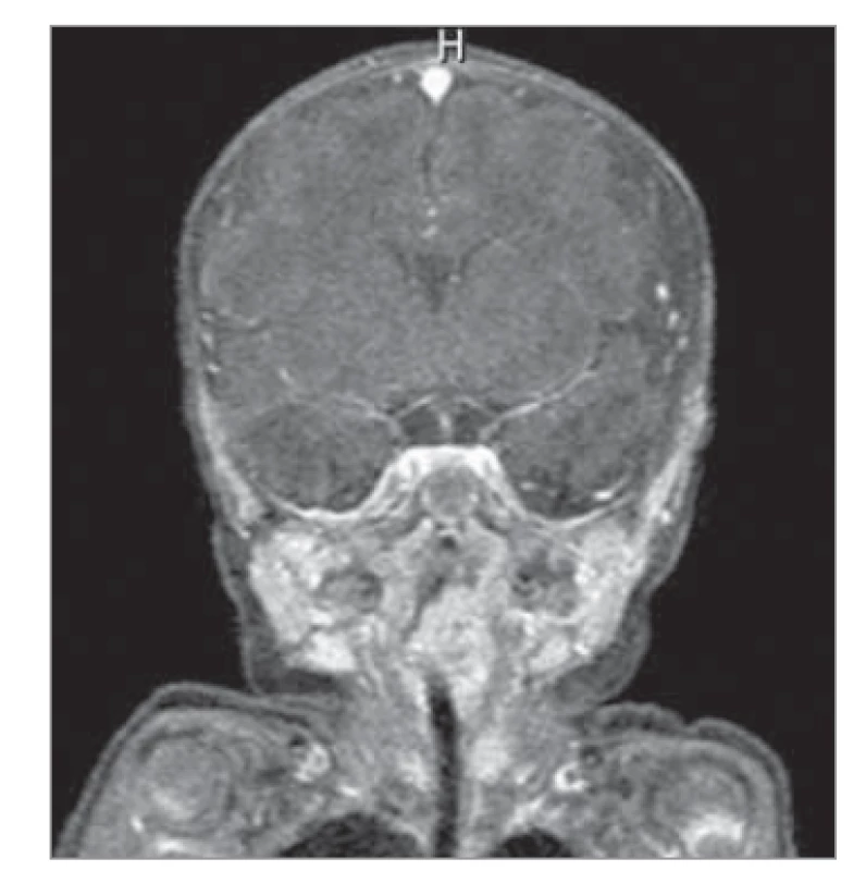 MR obraz, T1 vážený. Na
snímku patrný sytící se útvar obturující
vchod do laryngu.<br>
Fig. 1. MR image, T1 weighted. The
picture shows a saturating formation
obscuring the entrance to the larynx.