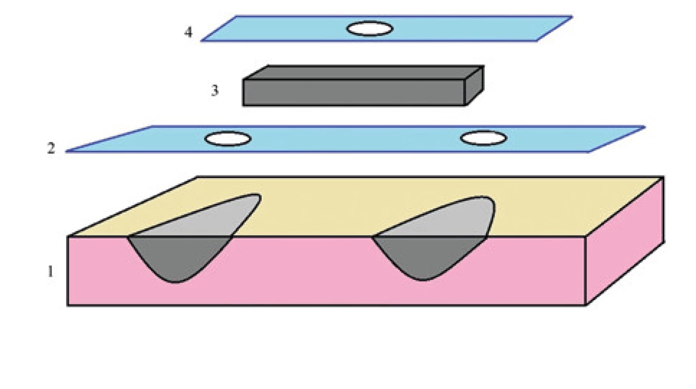 Struktura můstku<br> 1. tkáň s pěnou v ranách, 2. folie, 3. pěna, 4. folie <br>Fig. 8: Structure of the bridge<br> 1. tissue with foam in the wounds; 2. the drape; 3. the foam; 4. the drape