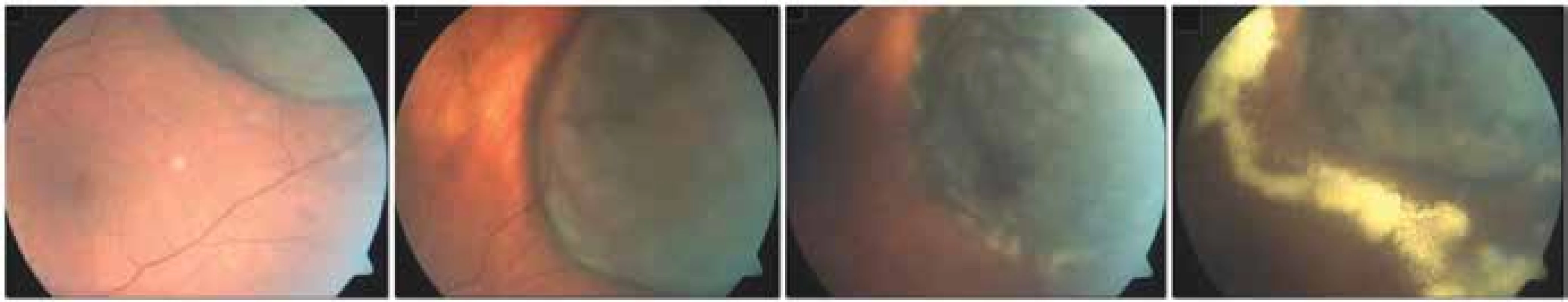 Development of signs of toxic tumour syndrome following treatment of large melanoma with the aid of LGK