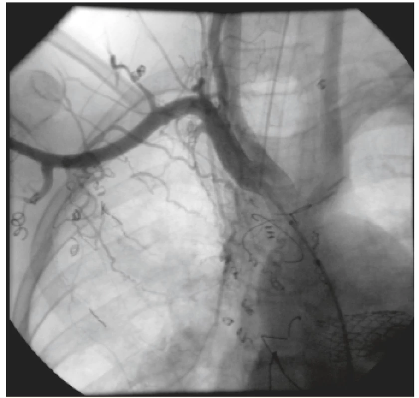 Angiografia znázorňujúca nástrek pravej podkľúčnej
tepny so 4 kolaterálami. V pravej časti hrudníka viditeľná
sieť vzájomne prepojených aorto-pulmonálnych
kolaterál (pacient 1).<br>
Fig. 1. Injection in a right subclavian artery showing 4 aortopulmonary
collateral vessels. Vascular bed of aortopulmonary
collaterals in the right hemithorax (patient 1).