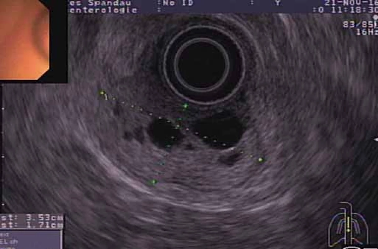 EUS – polypoidný nádor vychádzajúci zo submukózy steny duodéna s viacerými vnútrnými cystickými štruktúrami.<br> Fig. 3. EUS – polypoid tumour arising from a duodenal submucosa with multiple intrinsic cystic structures.