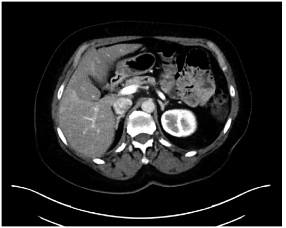 CT vyšetření při pokusu o biopsii ozřejmuje nehomogenní,
mapovitě steatotický jaterní parenchym bez
jednoznačné diferenciace ložiska<br>
Fig. 2. CT image taken during the intended biopsy showing
non-homogenic steatotic liver parenchyma, the lesion
cannot be clearly seen