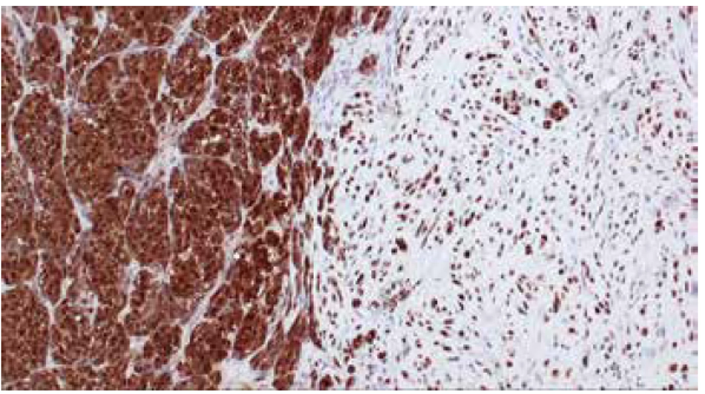 Imunohistochemická exprese S100 proteinu v nádorových melanocytech
a v chrupavce (IHC, zvětšeno 10x).