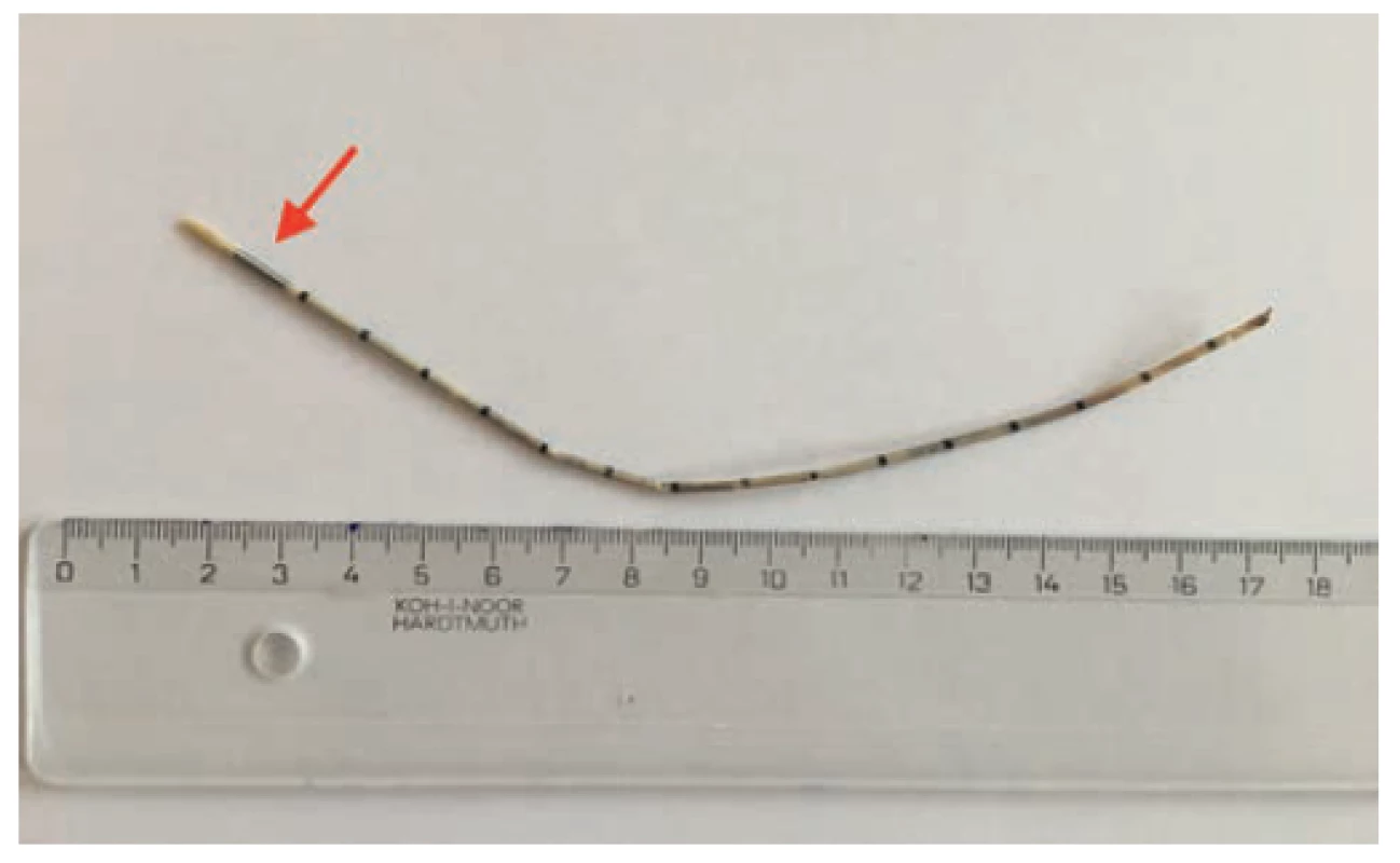 Extrahovaný zvyšok katétra o dĺžke takmer 20cm<br>
Fig. 3. Extracted catheter remnant with a size of almost
20cm