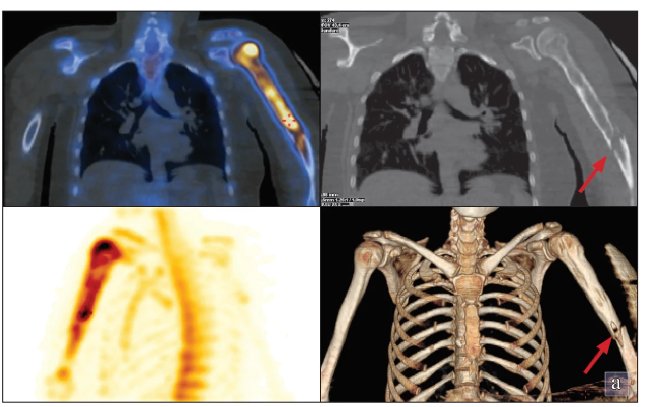 Na SPECT/LDCT hrudníku je zvýšená akumulace v hlavici a v diafýze levé pažní kosti s maximem v hlavici
laterálně. Na LDCT je zobrazena zlomenina v distální polovině diafýzy levé pažní kosti (označeno šipkou).