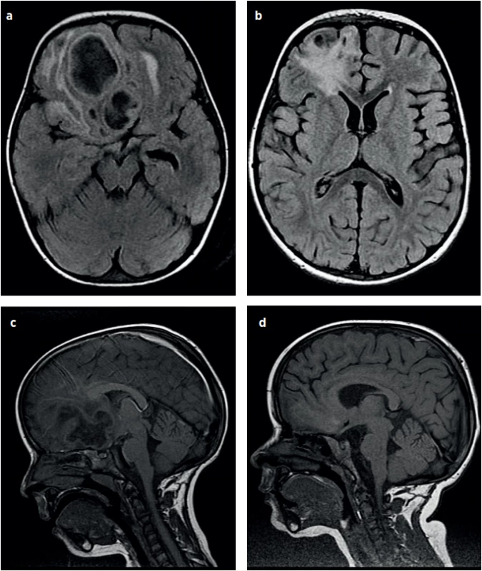 a–d (P2). NMR vyšetření hlavy, vývoj mozkového abscesu. 2. hospitalizační den (a, c); 49. hospitalizační den – výsledný stav (b, d).<br>
Fig. 6a–d (P2). Brain MRI, the brain abscess development. Day 2 of hospitalisation (a, c); Day 49 of hospitalisation – the resulting state (b, d).