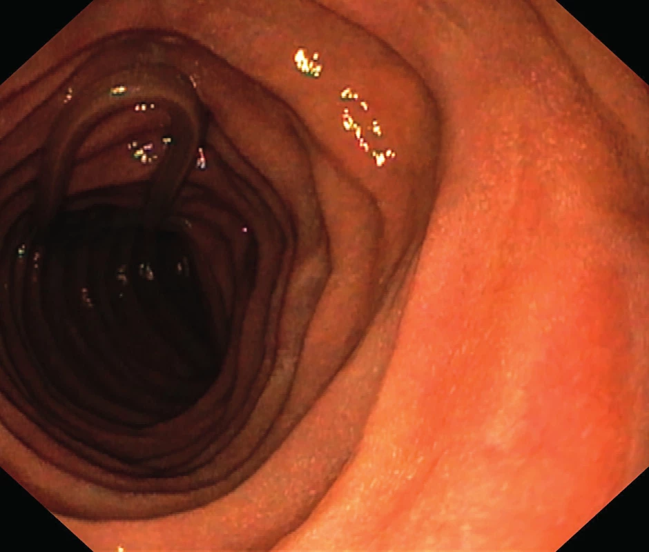 Škrkavka dětská připomínající minci v první kličce jejuna.<br>
Fig. 1. Ascaris lumbricoides in the first jejunal loop resembling
a coin.