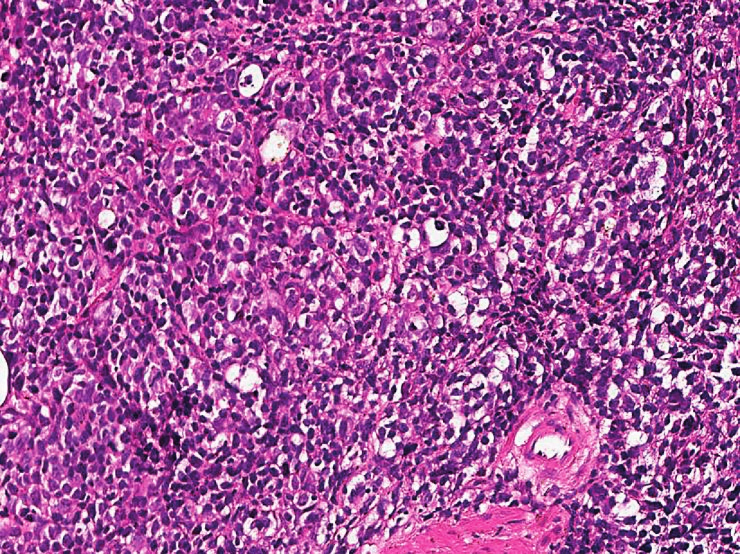 Histologie z biopsie mízní uzliny, zvětšení 200×, patrná zřetelná velkobuněčná transformace, barvení hematoxylin – eozin