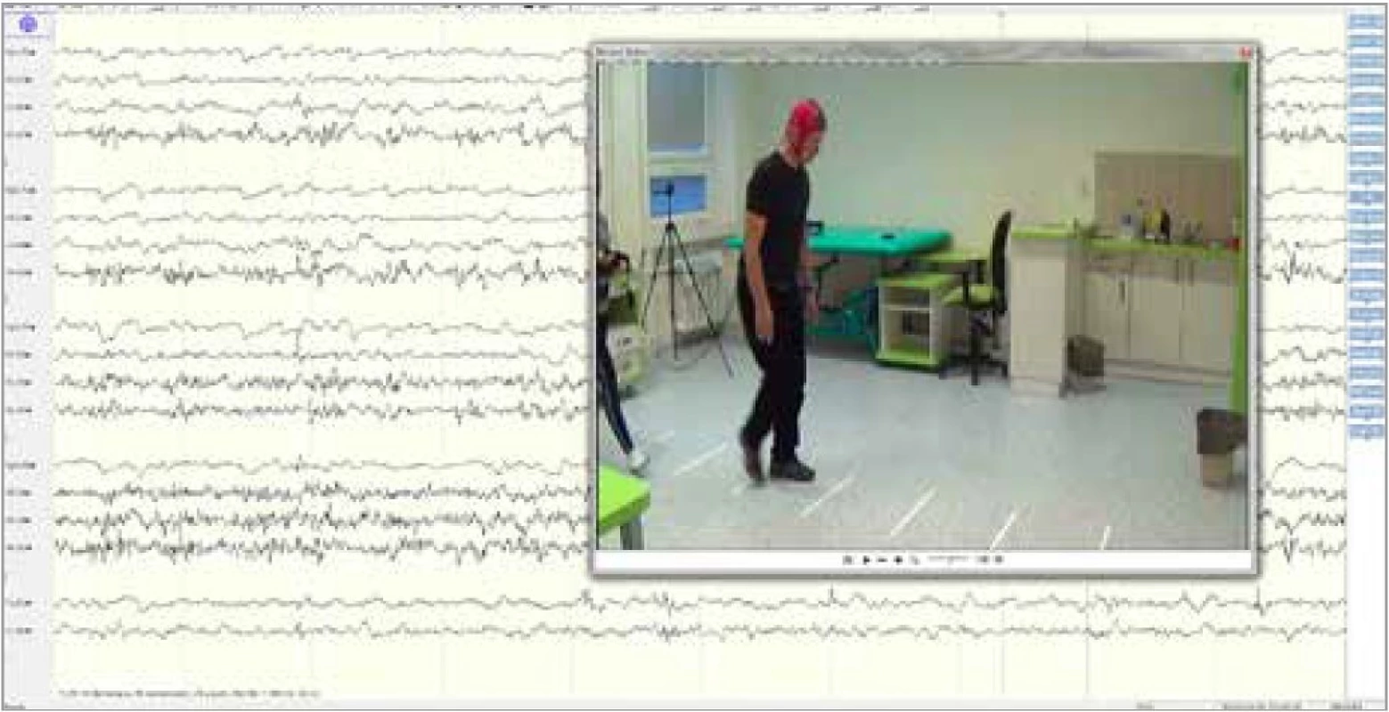 Ukázka z měření EEG při chůzi facilitované zevním zrakovým podnětem
u pacienta s Parkinsonovou nemocí. Zdroj: archiv autorky.<br>
Fig. 1. A demonstration of EEG recording during walking facilitated by external
visual cue in Parkinson’s disease patient. Source: author’s archive.