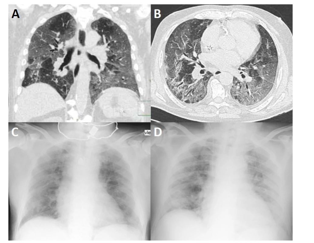 HRCT hrudníku (A, B) ukazuje rozsáhlé oblasti vyšší denzity typu „mléčného skla“ (ground glass opacities) se
zesílením interlobulárních sept v parenchymu obou plicních křídel s relativním ušetřením centrální části plic. V dolních
lalocích jsou zachyceny bronchiektázie (B). Na RTG (C, D) je patrná snížená transparence především v periferní části obou plicních křídel.