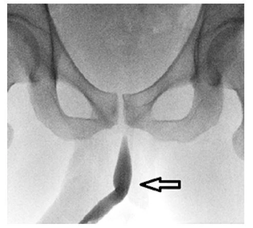 Vstupní retrográdní UCG: uretra přiměřeného
lumen, bez patologické komunikace, nebo útlaku
parauretrálně uloženou, ultrasonograficky diagnostikovanou
cystickou formací ve spongiózním tělese
bulbu (šipka)<br>
Fig. 1. Baseline retrograde UCG: the urethra with adequate
lumen, with no pathological communication or
compression by paraurethral cystic mass in the spongy
body of the bulb (arrow) diagnosed with ultrasound