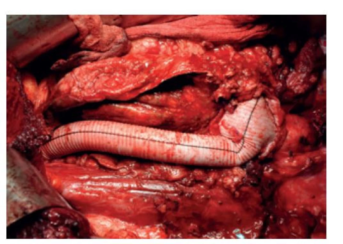 TAAA IV náhrada (operační snímek)<br>
Fig. 9: Reconstruction of a type IV TAAA (perioperative
photo)