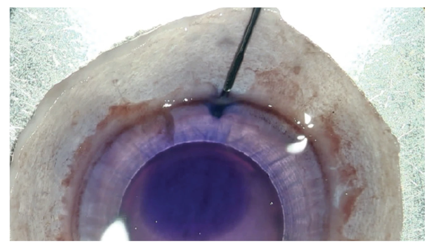 Needle is inserted into opening beneath DM in
such a manner as to separate DM from corneal stroma
and Dua’s layer