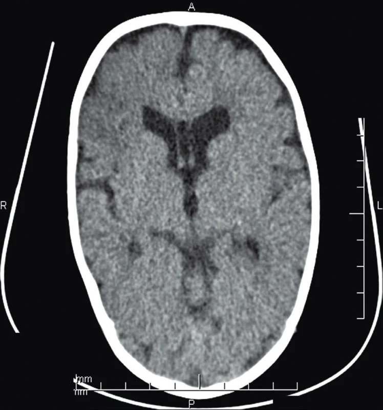 CT mozgu (vo veku 8 mes.) – vpravo frontálne, nehomogénna
škvrnitá hypodenzná area veľkosti 2,5 x 2
cm.<br>
Fig. 1. Brain CT (age 8 months) – non-homogenous spotty hypodense
area 2.5 x 2 cm in the right frontal lobe.