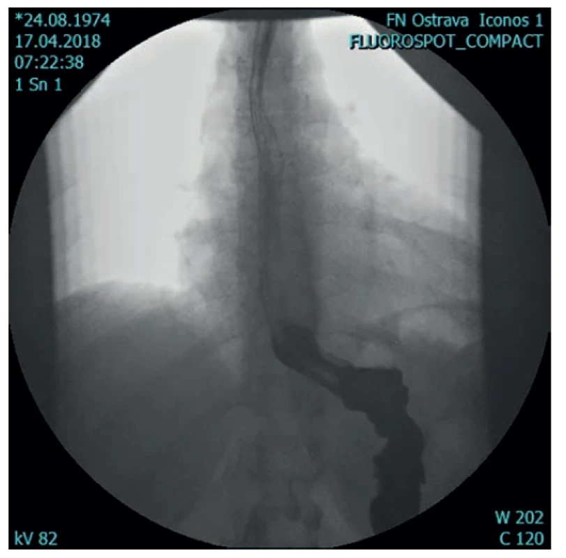 Před operací (hiátová hernie a GERD)<br>
Fig. 1. Before the operation (hiatal hernia and GERD)