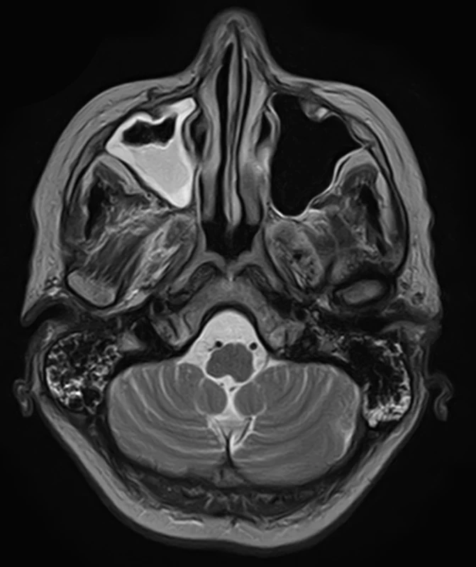 Brain MRI. Axial T2 weighted – progression of maxillar sinusitis, normal brainstem. <br>
Obr. 2. MR mozku. Axiální T2 vážený snímek – progrese sinusitis maxillaris. Normální nález v oblasti mozkového kmene.
