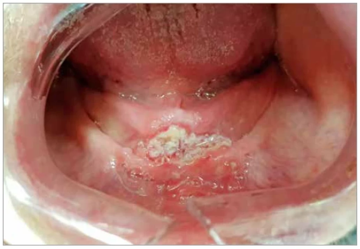 Oral squamous cell carcinoma of the floor of the mouth.