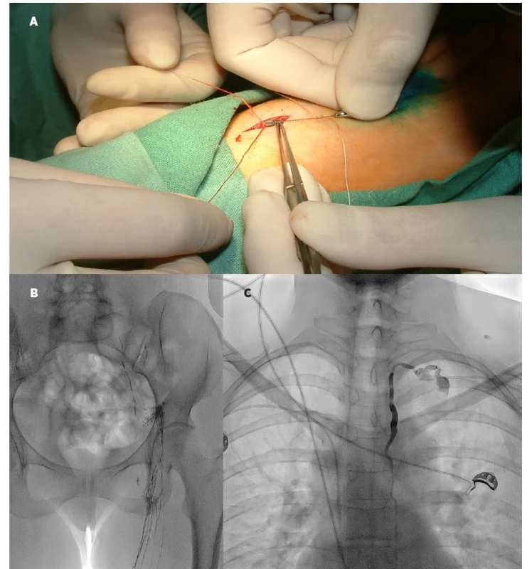 Kazuistika 1:<br>
A) jehla zavedená do mízní cévy na nártu levé nohy<br>
B) plnicí fáze lymfografie v oblasti pánve a břicha<br>
C) naplněný ductus thoracicus a extravazace kontrastní látky do dutiny se zavedeným drénem
