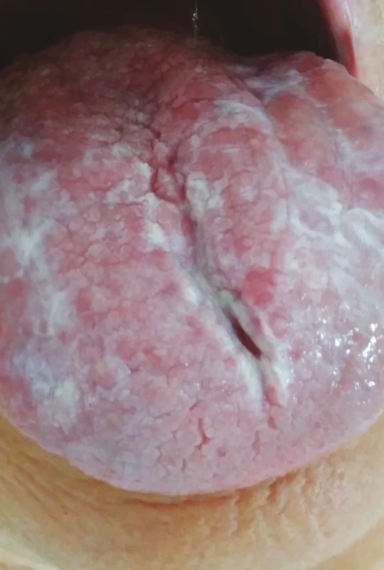 Orální lichen planus,
retikulární forma
(z archivu autorky)<br>
Fig. 7
Oral lichen planus,
reticular form
(author´s archive)