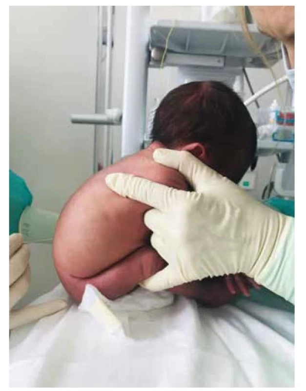 Poloha v sede (prone position) počas LP (archív Neonatologickej
klinike JLF UK a UNM)