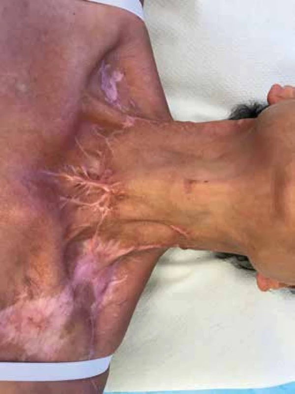 Kontrola po 5 mesiacoch <br>Fig. 6: Follow-up after 5 months