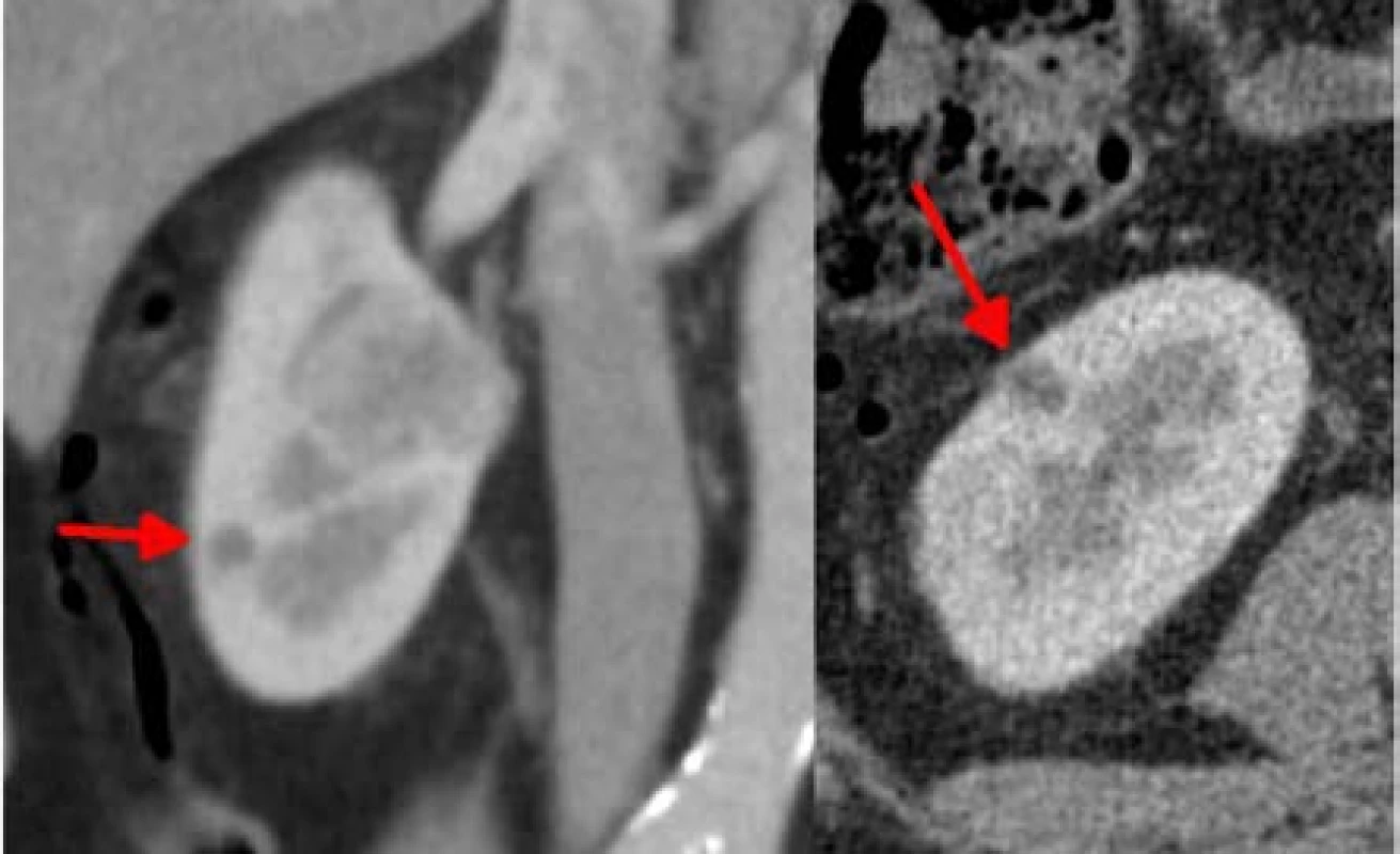 Ložisko velikosti 8 mm na ventrální ploše dolního
pólu, odstraněné jako sedmá oblast, bez ischemie<br>
Fig. 7. Smaller lesion of 8mm located on the lower
pole convexity, it was resected as the sixth one, without
ischemia