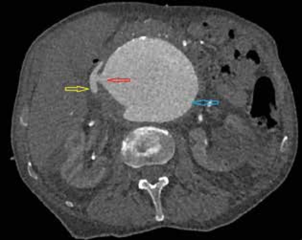 CT angiografie, axiální řez
Žlutá šipka − vena cava inferior, červená šipka − aorto-kavální
píštěl, modrá šipka - aneuryzma subrenální aorty. <br>
Fig. 1: CT angiography, axial cross-section
Yellow arrow − vena cava inferior, red arrow − aorto-caval fistula, blue arrow - infrarenal aortic aneurysm.