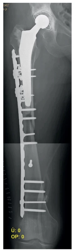RTG po první operaci<br>
Fig. 2: Postoperative X-ray after the first surgery