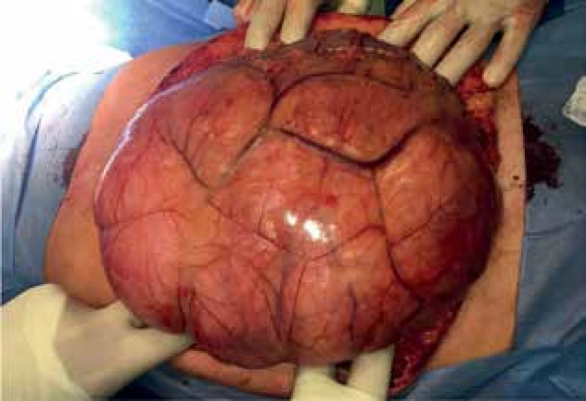 Peroperační nález I (liposarkom)<br>
Fig. 7: Peroperative finding I (liposarcoma)