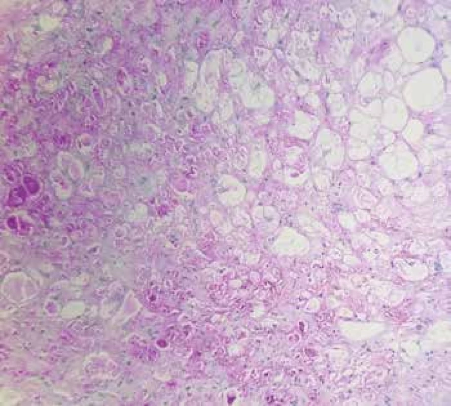 Obr. 1. A: Rhabdomyom srdce s přítomností pavoukovitých buněk (hematoxylin & eosin, 200x). B: Cytoplazmatická pozitivita glykogenu v nádorových buňkách (PAS, 200x). 