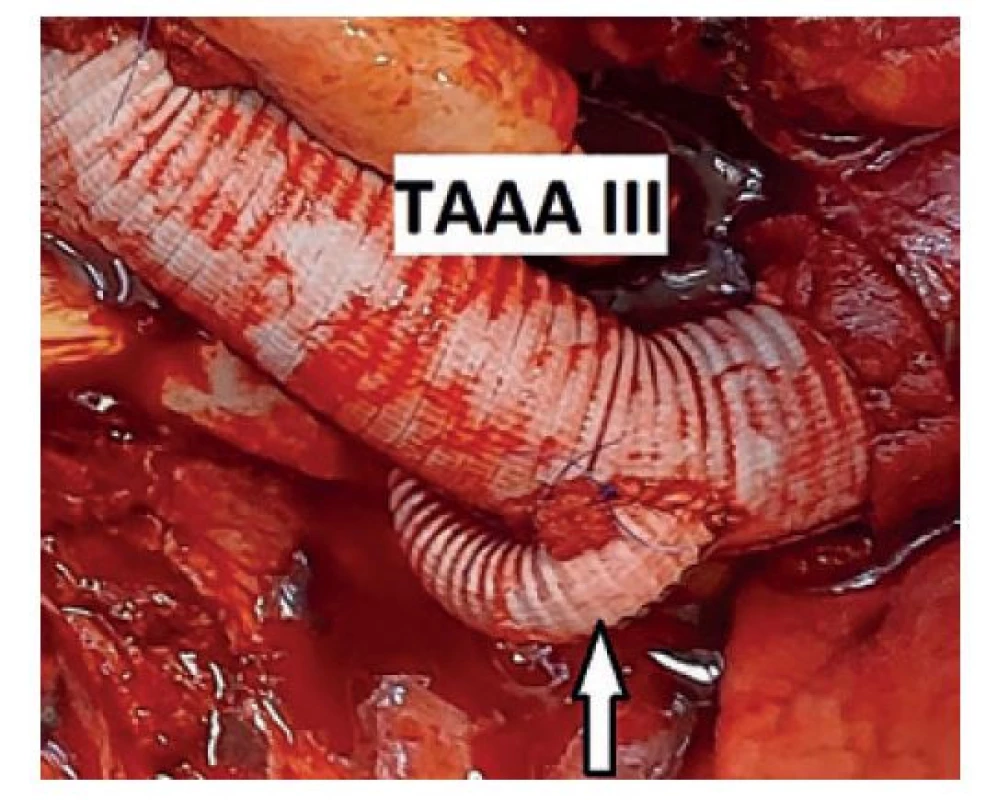 Reimplantace Adamkiewiczovy tepny (krátký bypass)<br>
Fig. 2: Adamkiewicz artery reimplantation (short bypass)