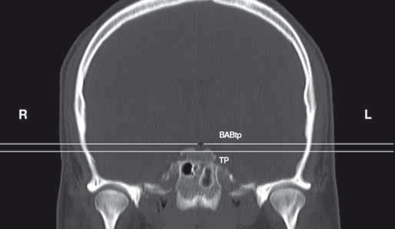 Position of the BAB in relation to the TP. Coronal reconstruction of CTA of the head.<br>
BAB – basilar artery bifurcation; BABtp – transverse BAB plane; L – left; R – right; TP – transverse plane; TP-BABtp – distance between the TP and BABtp expressed in mm<br>
+ a marker<br>
Obr. 3. Uložení BAB ve vztahu k TP. Koronární rekonstrukce CTA hlavy.<br>
BAB – bifurkace bazilární arterie; BABtp – transverzální rovina BAB; L – vlevo; R – vpravo; TP – transverzální rovina; TP-BABtp – vzdálenost mezi TP a BABtp vyjádřená v mm<br>
+ označení