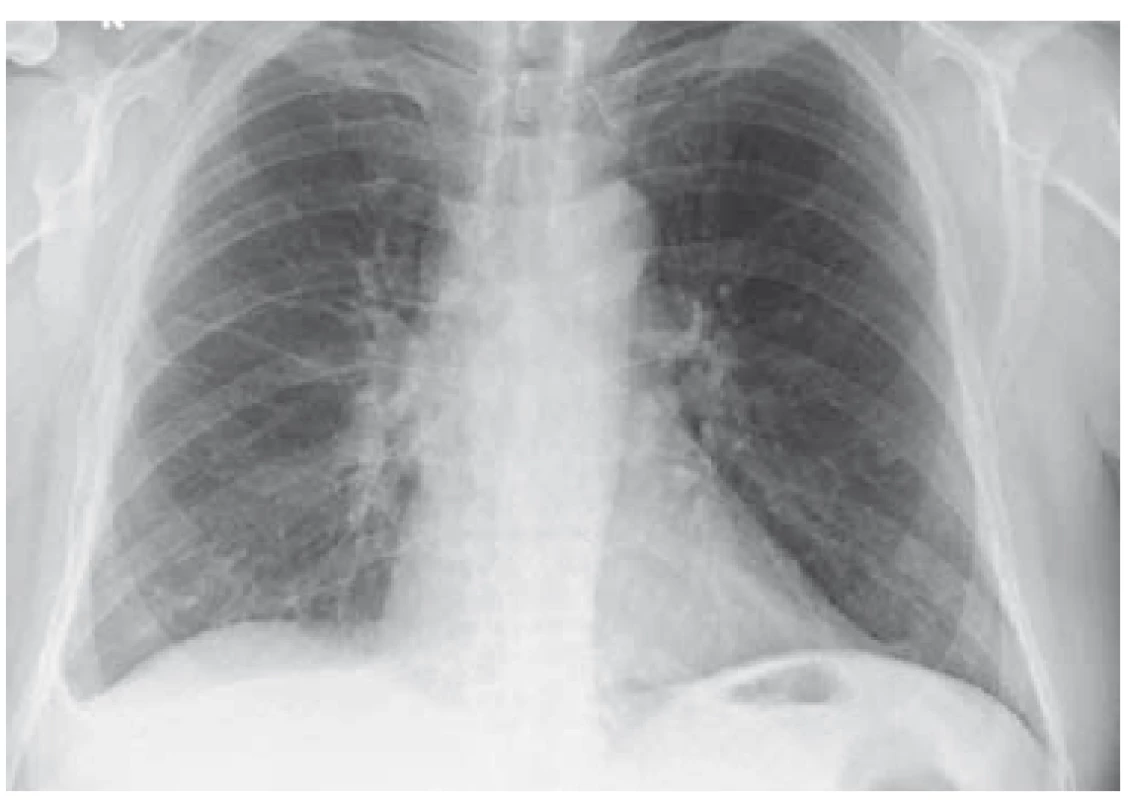 RTG plic – výpotek bazálně vpravo (6/2018).<br>
Fig. 3. Lung X-ray – basal right fluidothorax (6/2018).