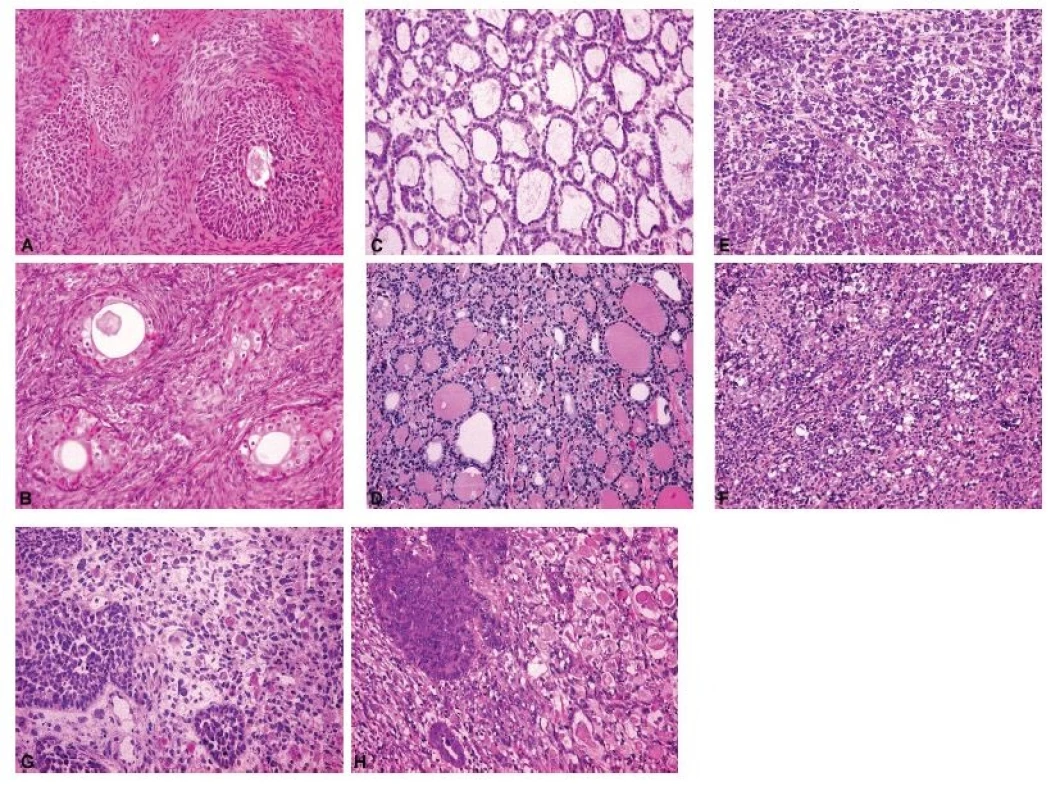 Spektrum peroperačních nálezů ovariálních nádorů různé histogeneze a biologického chování.<br>
A – Brennerův nádor (peroperační vyšetření, HE, 200x);
B – Brennerův nádor (definitivní vyšetření, HE, 200x);
C – monodermální teratom (struma ovarii) (peroperační
vyšetření, HE, 200x); D – monodermální teratom
(struma ovarii) (definitivní vyšetření, HE, 200x);
E – dysgerminom (peroperační vyšetření, HE, 200x);
F – dysgerminom (definitivní vyšetření, HE, 200x);
G – maligní smíšený Mülleriánský nádor (karcinosarkom)
s rhabdomyoblastickou komponentou (peroperační
vyšetření, HE, 200x); H – maligní smíšený Mülleriánský
nádor (karcinosarkom) s rhabdomyoblastickou
komponentou (definitivní vyšetření, HE, 200x)