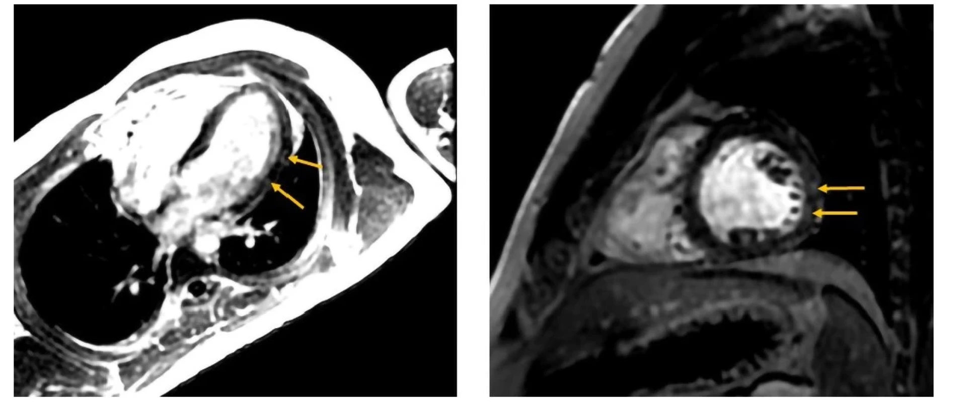 Oneskorená postkontrastná MDE (myocardial delayed enhancement) sekvencia v štvordutinovej projekcii (vľavo) a v projekcii v krátkej osi (vpravo).
Prítomné hyperintenzívne zmeny laterálnej steny – late gadolinium enhancement (šípky). Nemali korelát akútnych zmien – s primeranými hodnotami T1
a T2 máp (Klinika diagnostickej a intervenčnej rádiologie LF SZU a NÚSCH, a. s. – pracovisko magnetickej rezonancie; 30.09.2021)