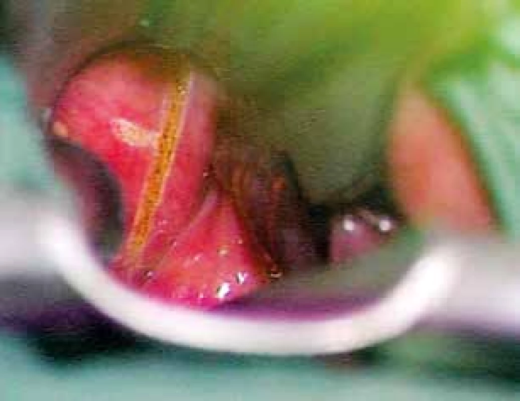 Resekce laryngokély – endolaryngeální přístup